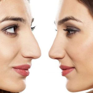 عمل زیبایی بینی ، نکات قبل و بعد از عمل بینی