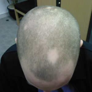 ریزش موی سکه ای چیست ؟ و تشخیص مشکل ریزش موی سکه ای